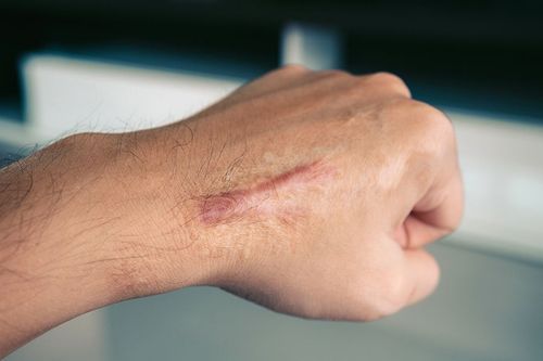 Symptoms of Keloid Scars: Causes and Treatment